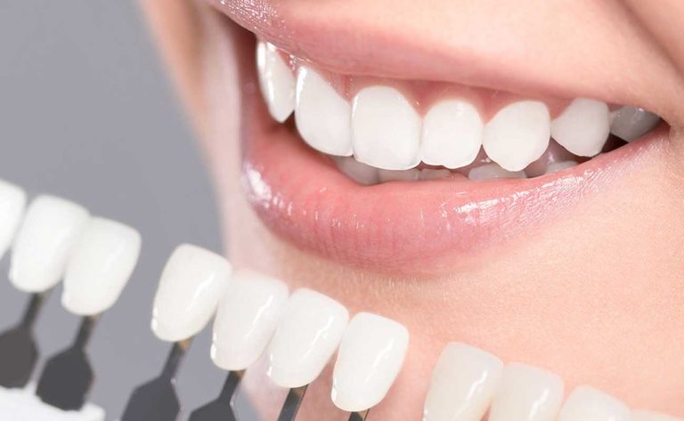 Four Signs That You Need Teeth Whitening. 