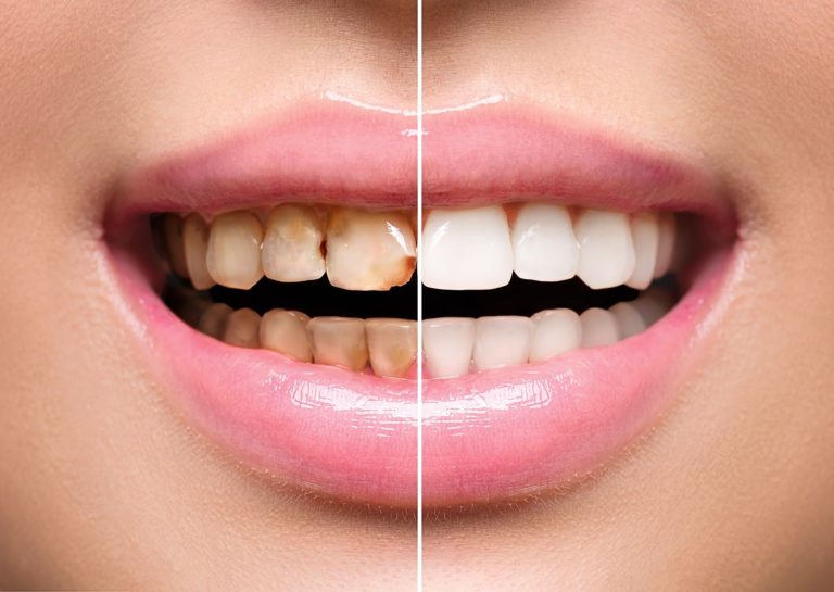 Types of Dental Restorations in Dacula